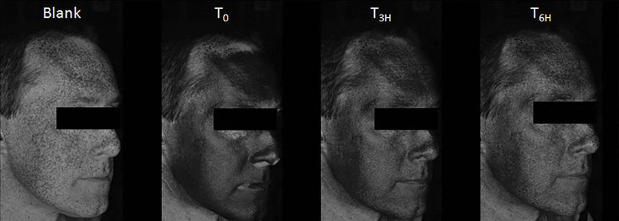 Sunscreen applied on whole face and evolution of the film during the day