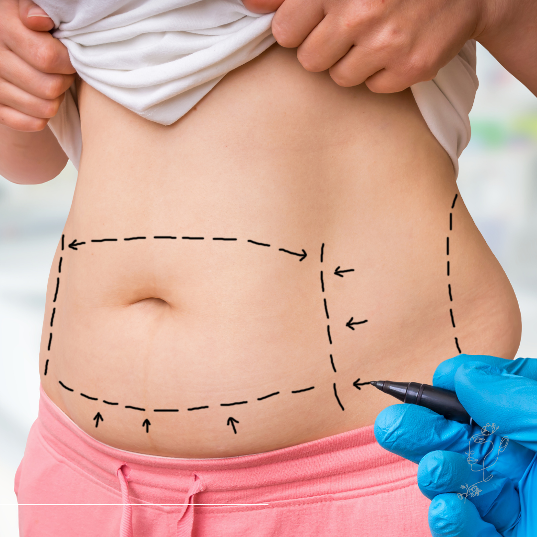 Zsírleszívás Budapesten: Hogyan válassz megbízható klinikát? - M2Med Blog