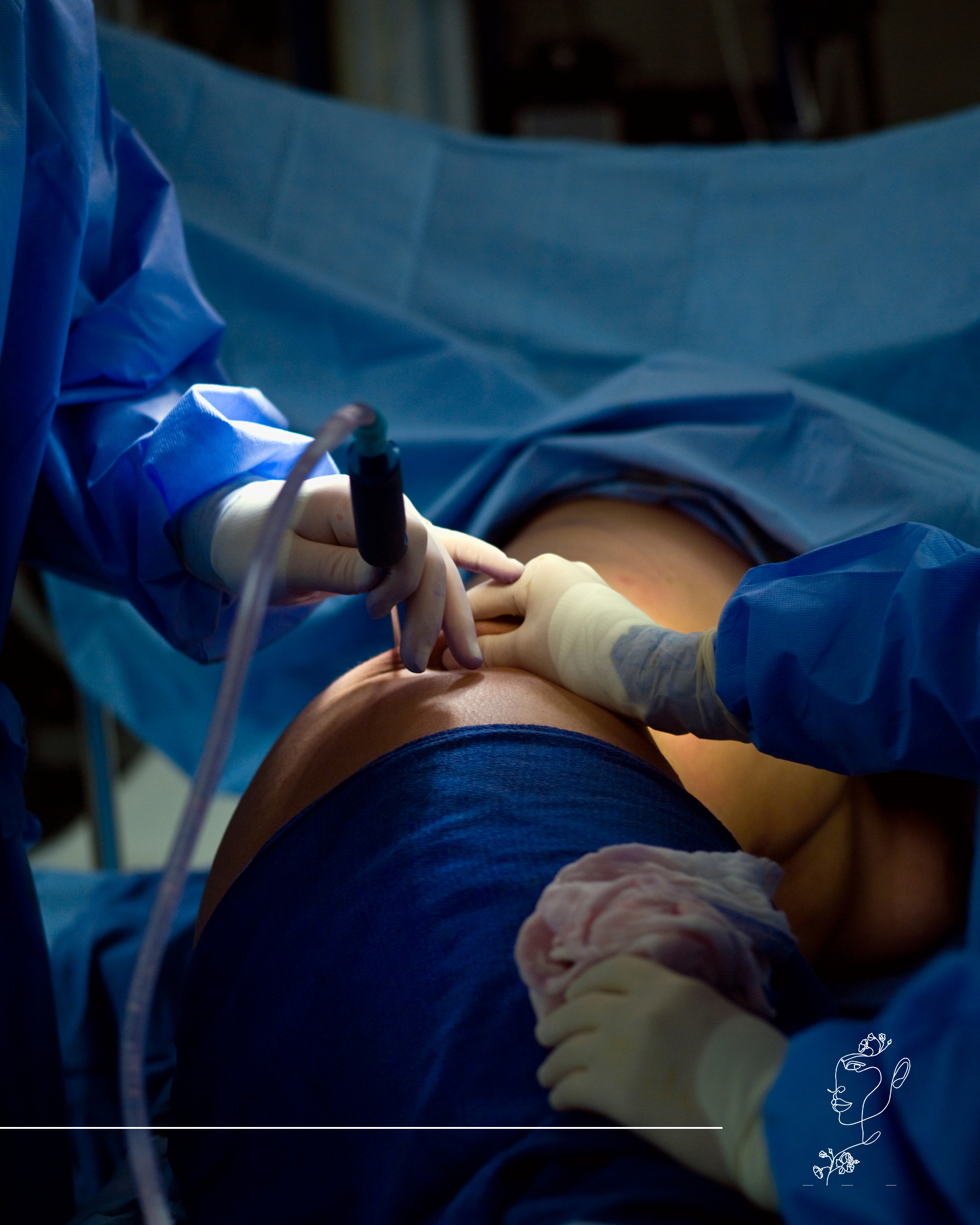 Zsírleszívás – a leggyakoribb kérdések és válaszok a beavatkozásról - M2Med Blog