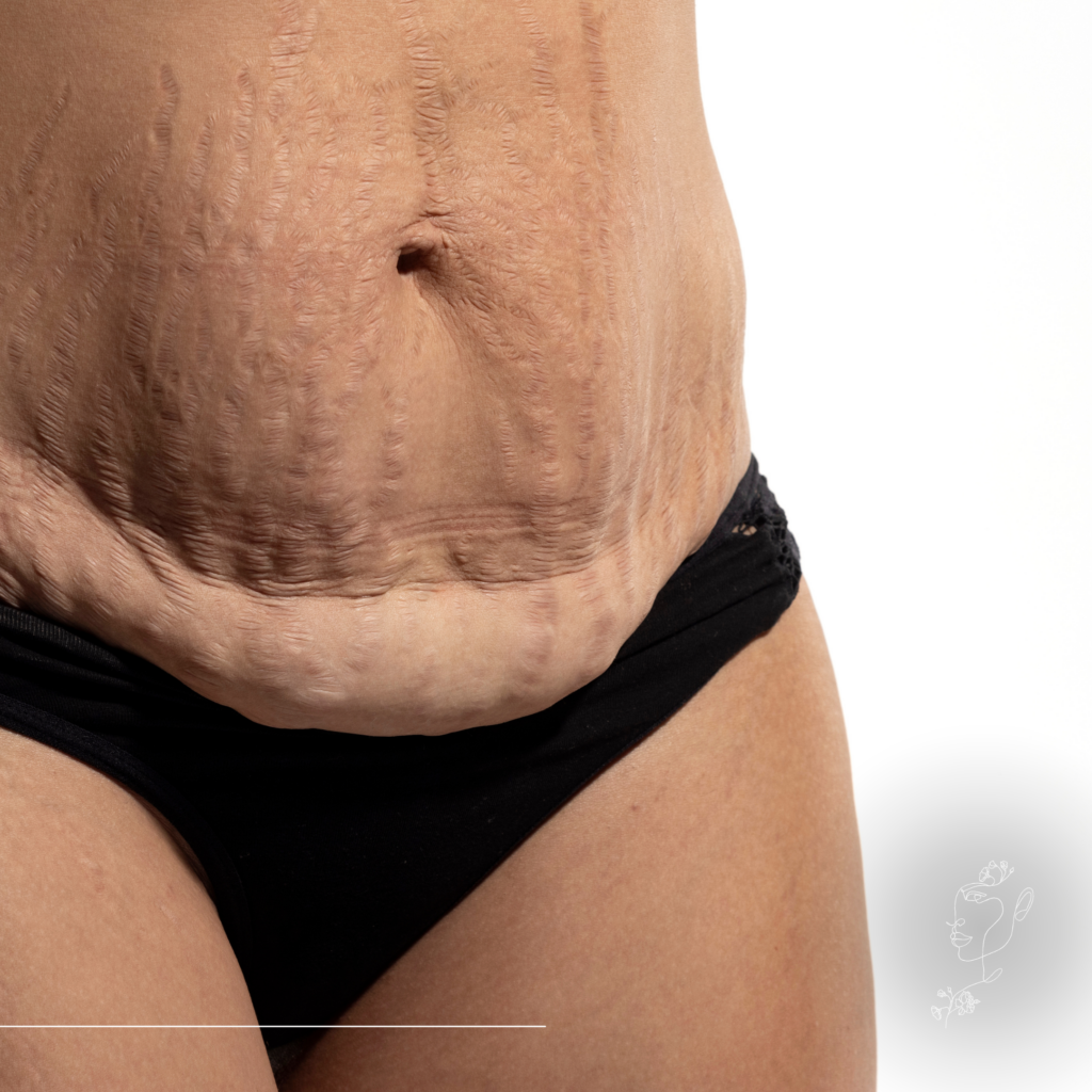 Zsírleszívás vagy hasplasztika – melyik való nekem? - M2Med Blog