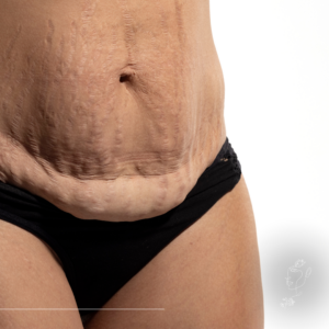 Lógó has vagy hasi zsír? Nem mindegy, miért nem lapos a has - M2Med Blog