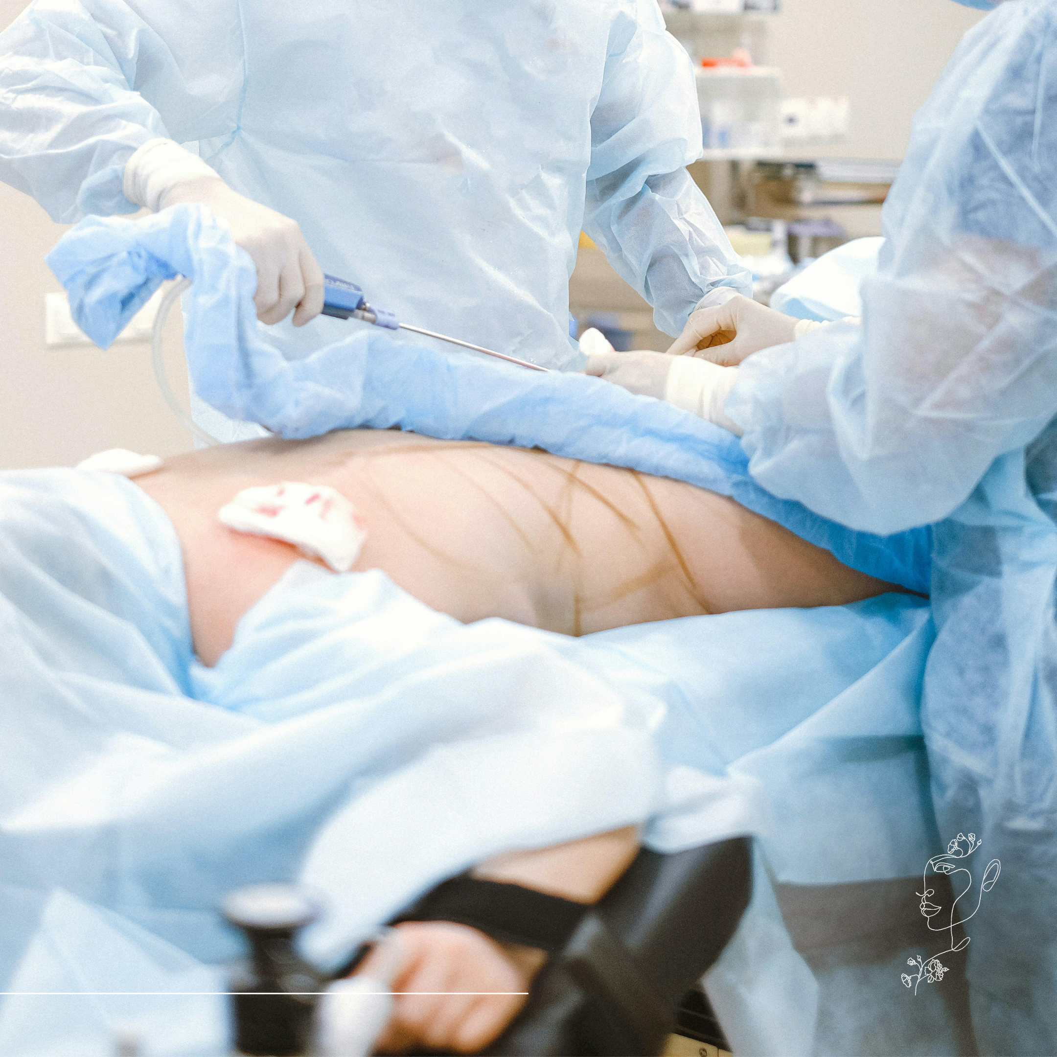 Zsírleszívás vagy hasplasztika – melyik való nekem? - M2Med Blog Zsírleszívás vagy hasplasztika – melyik való nekem? - M2Med Blog
